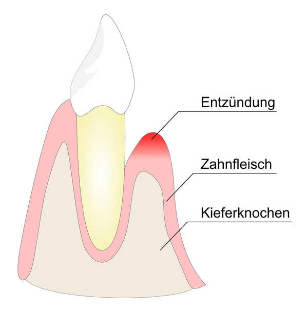 ZahnEntzuendung